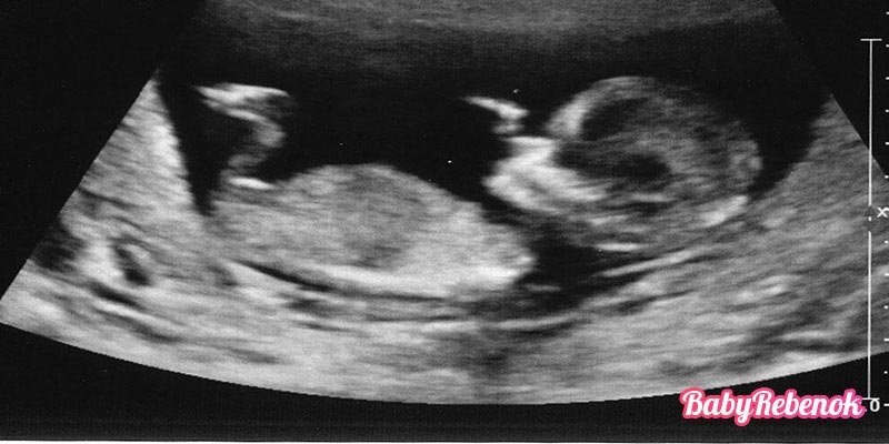 12 неделя беременности: фото, живот, УЗИ, ощущения