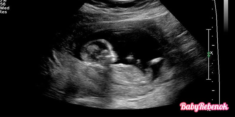 13 неделя беременности: ощущения, фото животиков, УЗИ