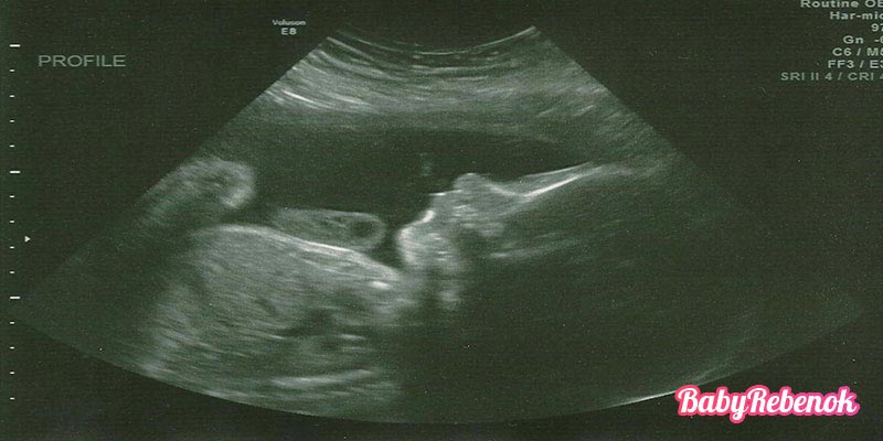 31 неделя беременности: фото животиков, УЗИ, вес плода