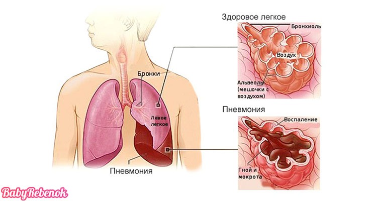 Пневмония у детей: признаки, симптомы, лечение, профилактика
