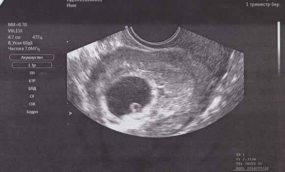 2 неделя беременности: признаки, симптомы, ощущения, фото