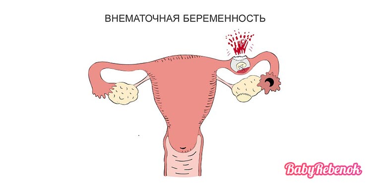 Признаки и симптомы внематочной беременности: причины, лечение