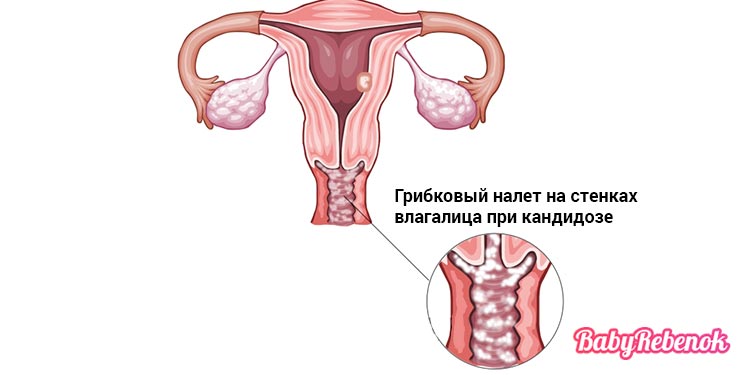 Молочница у женщин и мужчин: лечение, причины, симптомы